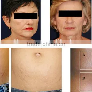6 in 1 Lipo Ultrasonic Cavitation Machine , RF 940nm Vacuum rf Device thumbnail-6