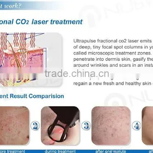 Professional Warts Removal 2016 Medical Co2 Skin Therapy Ultra Pulse Equipment Fractional Co2 Laser/vaginal Rejuvenator Laser Skin Tightening thumbnail-3