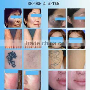 Hot-selling 1064 nm 532nm nd Yag Laser Tattoo Removal Machine thumbnail-6