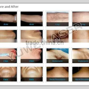 Best Price Salon Use Diode Laser Hair Removal Machine Price thumbnail-5