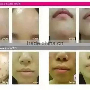 Led Photomodulation Korea Led Light Pdtmachine thumbnail-3