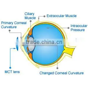 MCT Technology for Daily Eyes Contact Lenses thumbnail-1