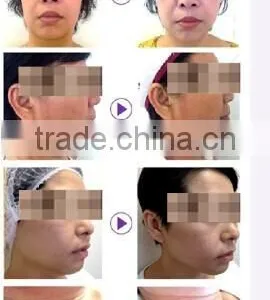 Reduction of Wrinkle, Dark Color, Puffy Skin Remage Device thumbnail-4