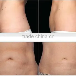 Portable Cryolipolysis for Home Use Has a Very Good Effective for Body Slimming thumbnail-6