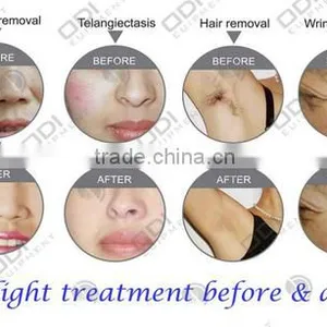 Beauty Machine Tattoo/hair Removal Beauty Salon/spa OD-IRL10 IPL RF E Light nd Yag Laser Price thumbnail-6