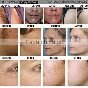 Beijing KES Beauty MACHINE Skin Whiten Pigmentation Removal Machine thumbnail-4
