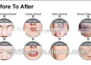 Express Acne Light, Elight Ipl Rf Nd Yag Laser, Light Ipl thumbnail-2