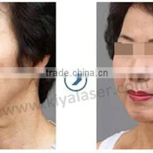 Top Quality!! Ultra Age HIFU / HIFU Face Lift / HIFU Lifting for Skin Tightening and Wrinkle Removal thumbnail-3