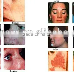 Wrinkle Removal Best Choice Face LED PDT Led Pdt Bio-light Anti-aging Therapy 7 Color Lights Pdt Machine In Usa Spot Removal thumbnail-6