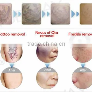 Q Switched nd Yag and Ruby Laser thumbnail-3