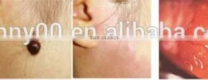 Benign Familial Pemphigus Treatment Laser Machine/co2 Laser Machine for Surgical thumbnail-5