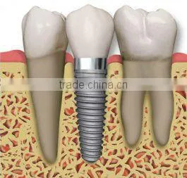 Dental Implants thumbnail-1