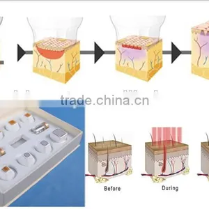 Hot Sale Portable Home-use RF 9D Thermacool Skin Resurfacing and RF Thermacool Effectively Machine thumbnail-4