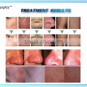 USA Hot Sales NUBWAY Portable Mini Skin Tag Removal Lamprobe Machine thumbnail-4