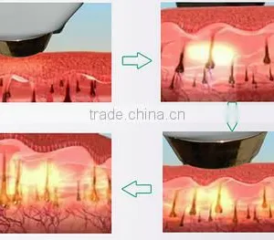 Best Soprano Laser Hair Removal Machine Price thumbnail-3