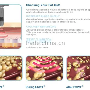 Latest Lipolysis RSWT Shockwave System Therapy For Body Fat Removal - Criowave 2016 thumbnail-5