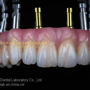 Dental Implant Prosthesis, Implant Denture, Dental Prosthesis, Laboratoire Dentaire, Dentallabor, Laboratorio Dental, Dental Laboratory, Shenzhen LJ Dental Lab China thumbnail-1