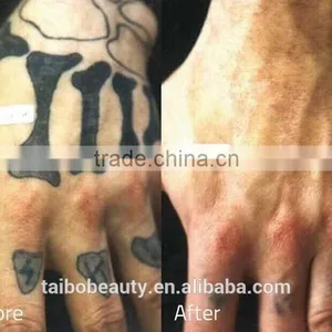 1 HZ 2017 Best Selling Laser Tattoo Removal Q 1500mj Switch Nd Yag Laser Beauty Machine For Sale thumbnail-6