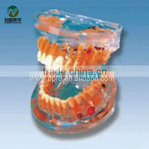 BIX-L1008 Transparent Pathologic Teeth Model thumbnail-1