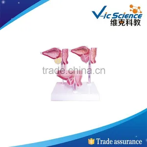 Best Price Good Quality Prostate Pathology Model thumbnail-1