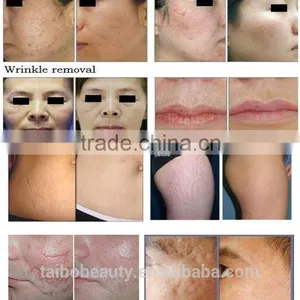 Skin Resurfacing 10600nm Laser Beauty Equipment Fractional Laser Vaginal Tightening CO2 Extraction Machine Stretch Mark Removal thumbnail-6