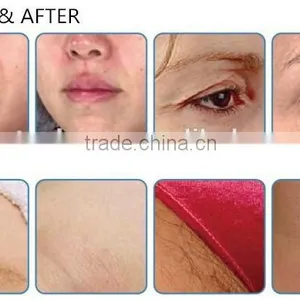 High Intensity RF Machine for Skin Tightening Face Lifting thumbnail-5