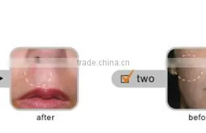 Promotion Best Professional Homeuse Acne Scar Laser Treatment Device thumbnail-6