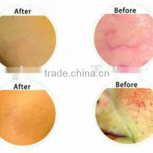 980nm Diode Laser Vascular Removal/Veins Removal Portable Machine Price thumbnail-6
