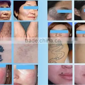 2016 Most Effective Best Q Switch Nd Yag Laser 1000W Machine For Tattoo Removal Birthmark Removal And Pigmentation Treatment 1-10Hz thumbnail-5