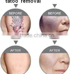 New Portable Q-switch nd -yag Tattoo/coffee Spots/senile Plaque/Birthmark Beauty Spot Removal Permanently Laser no Pain Beauty m thumbnail-6