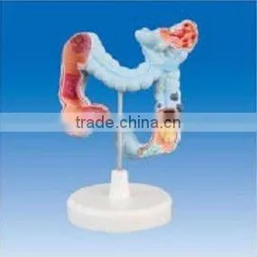 Colon Model Pathological Model of Colon thumbnail-1