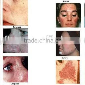 Led Light For Skin Care 2016 Popular In Many Countries Bio Light Therapy LED PDT Skin Rejuvenation Therapy Skin Rejuvenation thumbnail-6