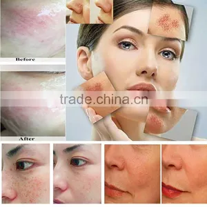 Hair Removal and Skin Rejuvenation Beauty Device With 2 Lamps Under Medical CE thumbnail-5