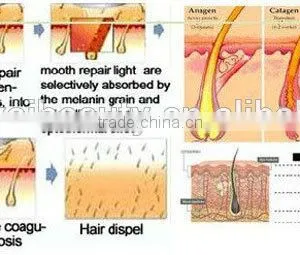 Elight /YAG Laser Elight Hair Removal Machine thumbnail-4
