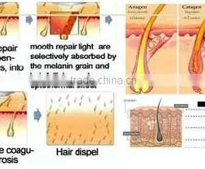 Strong Power !!! Newest Design Best Quality 3 Handles Ipl Multifunction Beauty Machine thumbnail-2