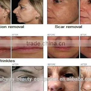 Vaginal Rejuvenation 30W High Power Fractional Co2 Skin Tightening Laser Beauty Machine Skin Treatment Device thumbnail-6