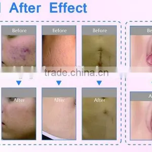 Wrinkle Removal Anybeauty F7+ Beauty Device 15W(20W) Fractional CO2 Laser Equipment Vaginal Tightening Machine thumbnail-5