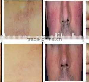 High Frequency  HIFU-C New Tech! HIFU Forehead Wrinkle Removal For Face Body Slimming Machine/liposunic Ultrasound Machine/cellulite thumbnail-3