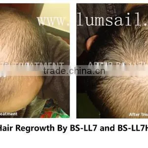 Fine Design Bio Laser Hair Growth Machine/Hair Regrowrth Device/ Hair Loss Treatment Instrument thumbnail-2