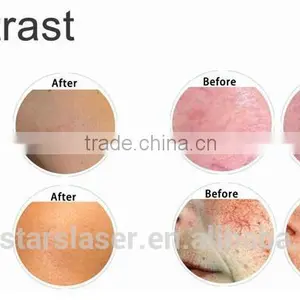 Spider Veins Removal / Laser Vascular Lesions / 980nm Diode Laser thumbnail-6