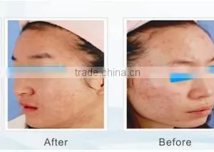Acne Removal,skin Rejuvenation, Scar Removal Light Therapy System thumbnail-2