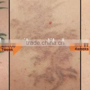 Most Effective Tattoo Removal YAG Laser Equipment thumbnail-2