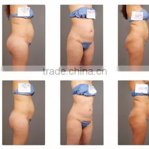 HIFU Ultrashape Body New 300W Slimming Technology Machine 7MHZ thumbnail-6