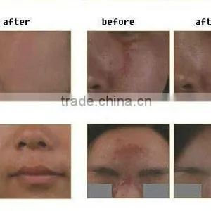 rf Fractional Co2 Metal Tube Home Laser Scar Removal thumbnail-2