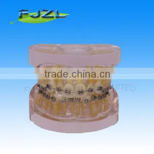 Orthodontic Teeth Model(Transparent Model , Dislocation Tooth, Common Brackets),dental Orthodontic Models thumbnail-1