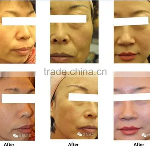 Skin Tightening Anybeauty Portable Hifu Slimming Machine Ultra Age Hifu Cartridge Face Lifting thumbnail-2