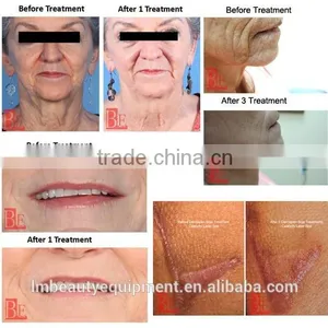 Fractional Radiofrequency Micro Needles for Permanent Makeup thumbnail-6