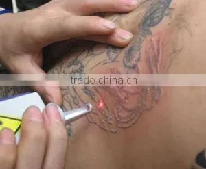 Q Switched 1064nm 532nm ND YAG Laser Tattoo Removal Pigment Removal thumbnail-5