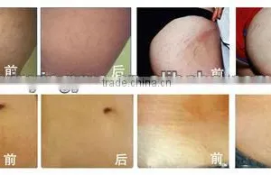 Wart Removal Salon Vertical RF Co2 Wrinkle Removal Fractional Laser Skin Treatment Machine Sun Damage Recovery Sun Damage Recovery thumbnail-6