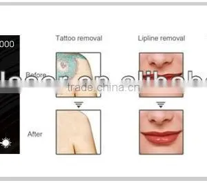 Good Quality Portable q Switched Tattoo Removal Equipment thumbnail-5